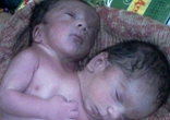 印度女子産下雙頭男嬰 共用心臟等器官