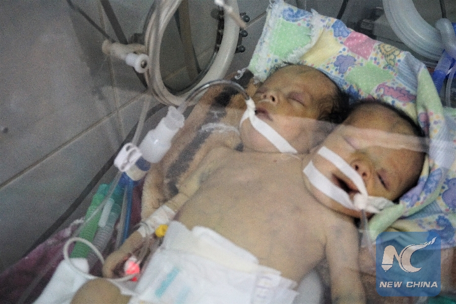 Yemeni Conjoined Twins Die Awaiting Transfer Abroad For Lifesaving Surgery Xinhua English 7893