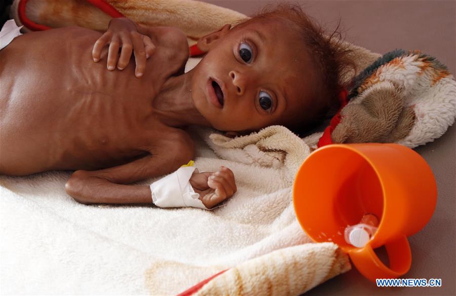 YEMEN-SANAA-CHILDREN-MALNUTRITION