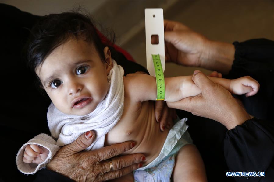 YEMEN-SANAA-HEALTH-DIPHTHERIA