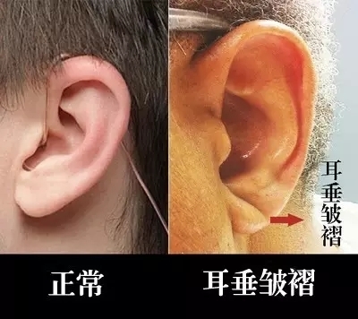 1.耳垂皱褶