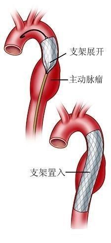 新桥医院心内科成功为主动脉夹层孕妇施行封堵术