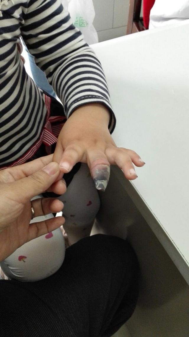 女童因创口贴使用不当手指末端坏死需要截肢