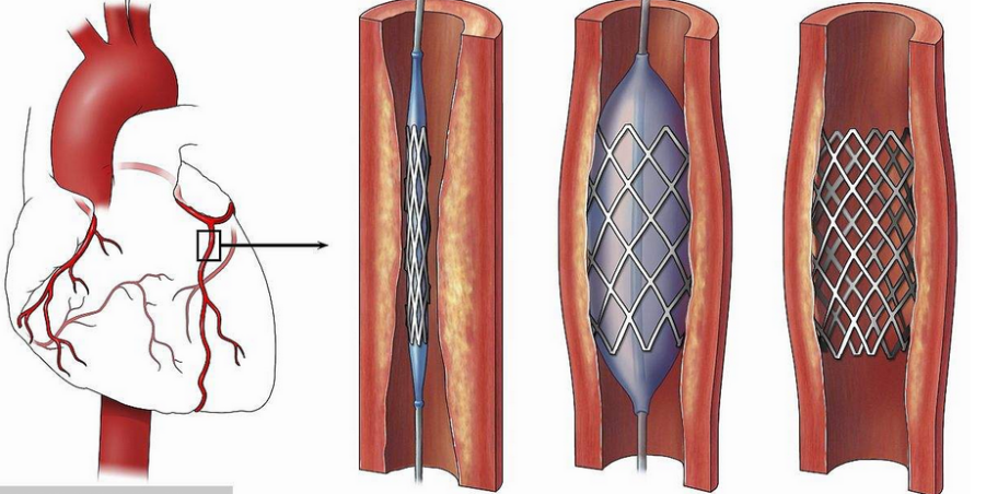 冠状动脉支架手术