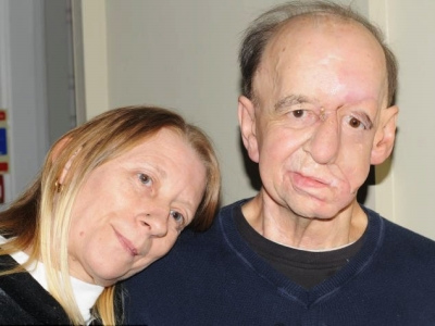 资料图片:3D打印技术可帮助重建面部。