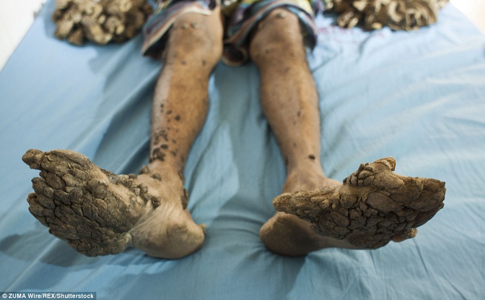 bajandar的手脚因疣样病变,严重增生仿佛树根,被当地人戏称为"树人"