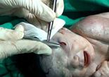 孕妇被炮火击中 叙利亚医生剖腹产救活“弹片婴儿”